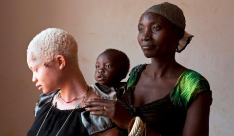 El Papa Francisco lanza la campaña 'Help African Albinos'